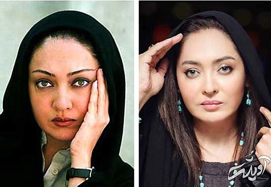 جراحی افتادگی پلک؛